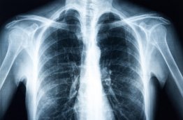 Akciğer Grafisi